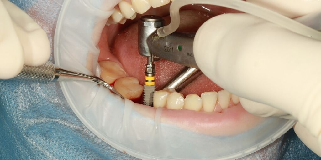 Image of Dental Implant