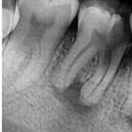 X Ray image of a Decayed tooth