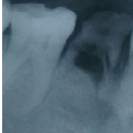 X Ray image of a Retained Deciduous tooth