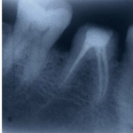 X Ray image of a Root Canal Tree