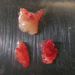 Image of Extracted Tooth