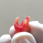 Extracted Wisdom Tooth image