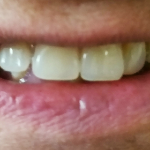 Image of a patient wearing removable Denture