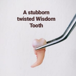 Image of an extracted Wisdom Tooth