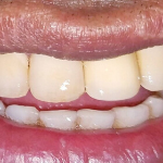 zirconia crownImage of a patient treated for root canal treatment and Zirconia Crowns