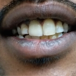 Image of a patient treated for root canal treatment and Zirconia Crowns