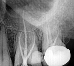 Dr Pramila, Root Canal Treatment Specialist in Noida performing a RCT on a patient